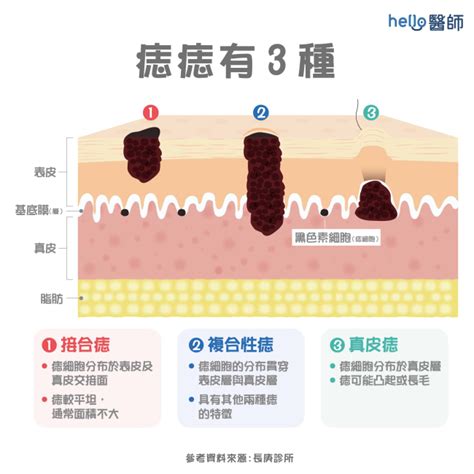 痣長毛代表什麼|痣變大、痣多或長毛會變皮膚癌？認識痣的形成與原因